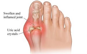 Read more about the article Gout